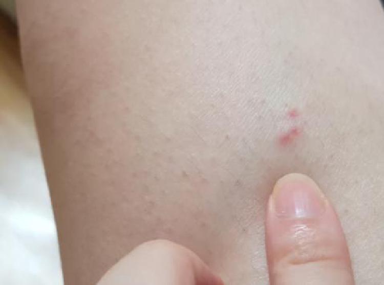 권연벌레 물린자국, 모기와 다르다? 집에서 갑자기 생기는 이유와 대처법