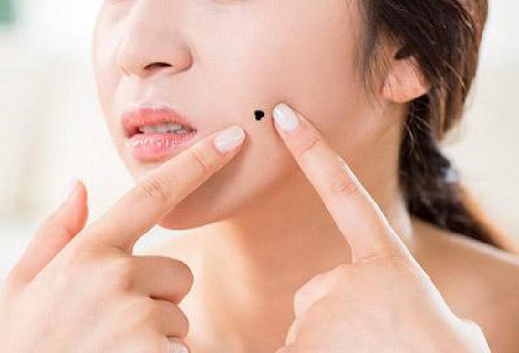 얼굴에 점 빼기 부작용, 진짜 후회한 사례들