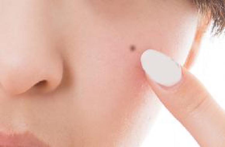 얼굴에 점 빼기 통증, 진짜 무섭지 않아? 내 피부과 후기 폭로